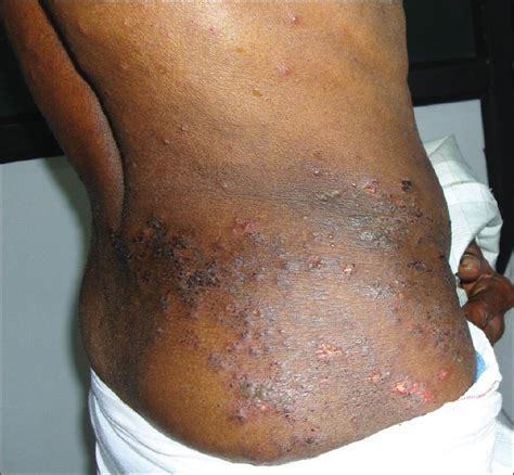 Herpes Zoster A Clinical Study In 205 Patients Abdul Latheef E N