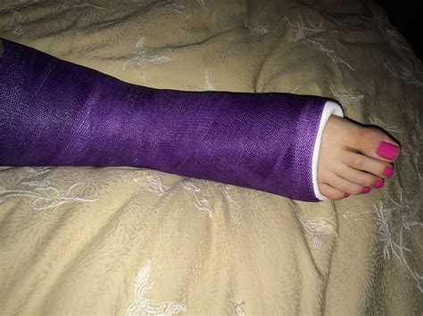 Broken Ankle Purple Cast A Photo On Flickriver