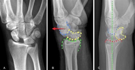 Splinter Series A Case Of Traumatic Wrist Pain After Fall