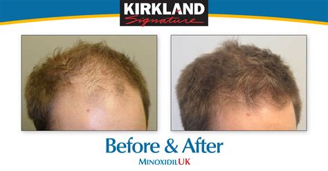 How long until you see results? Minoxidil Before and After. A Few Photos to Encourage You!