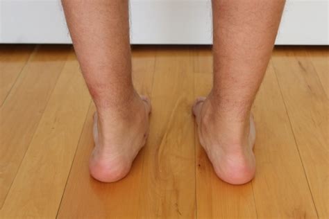 Flat Feet And Treatment For Pronation Rivervale Rivervale Podiatry