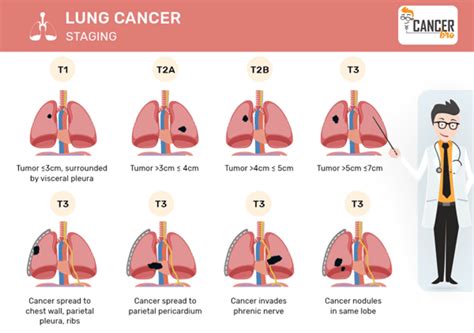 Tnm Staging Lung Cancer The Eighth Edition Lung Cancer Stage