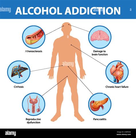 Alcohol Addiction Or Alcoholism Information Infographic Illustration
