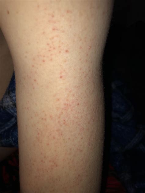 Skin Concerns Red Bumps All Over Upper Arms And I Dont Know How To Deal With Them R