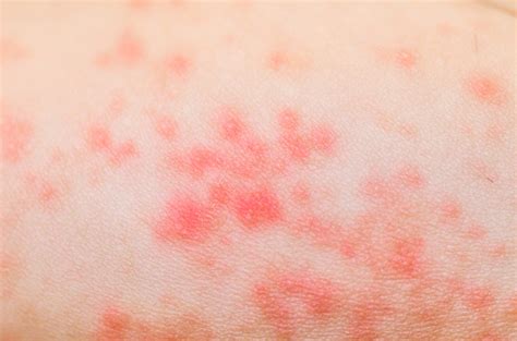 Ill Allergic Rash Dermatitis Eczema Skin Texture Stock Photo Download