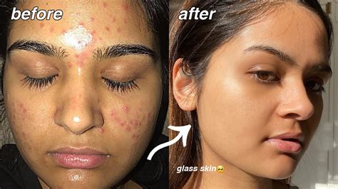 How I Cleared My Acne For Good Something Finally Worked Youtube