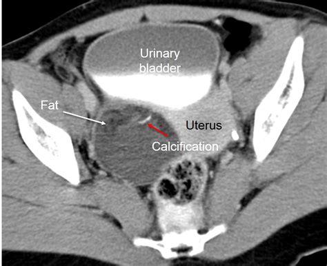 Mature Cystic Teratoma Transvaginal Us Scan Shows A Complex Ovarian