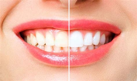 Teeth Whitening With Lemon Baking Soda At Home 6 Effective Remedies