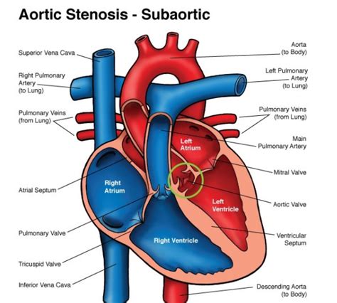Post Delivery Graphic Anatomy Valvar As And Subaortic Stenosis Ob