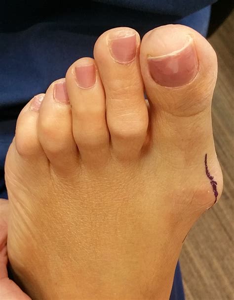 Surgical Correction Of Bunions Podiatric Surgery Centre
