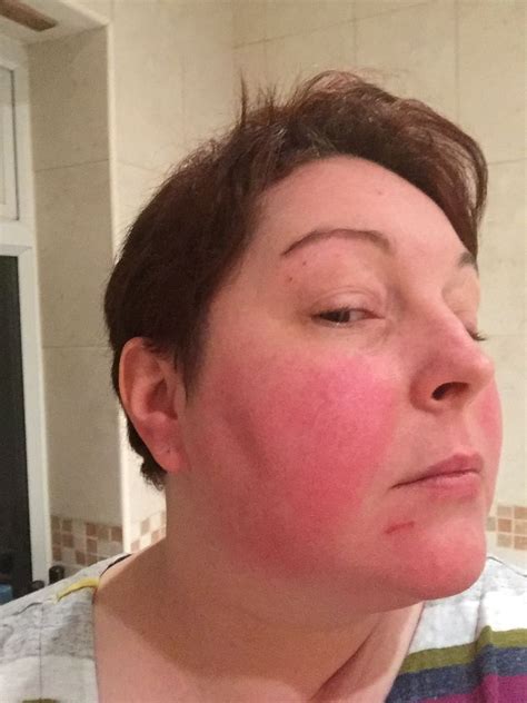 Lupus Can Cause A Red Butterfly Shaped Rash Across The Nose And Cheeks