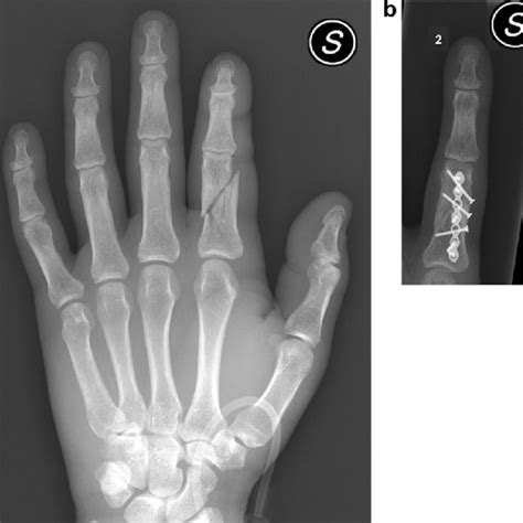 Ap View Of The Multifragment Displaced Fracture Of The Proximal