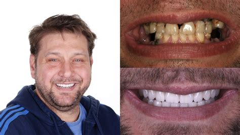 before and after composite veneers whitening 2