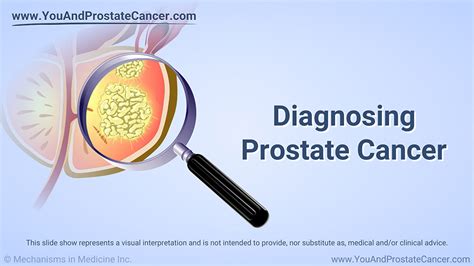 Slide Show Diagnosing Prostate Cancer