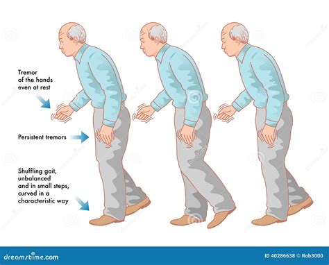 Parkinsons Disease Cartoon Vector Illustration