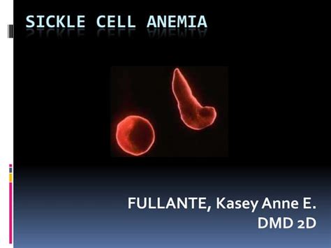 5 Fullante Sickle Cell Anemia Ppt