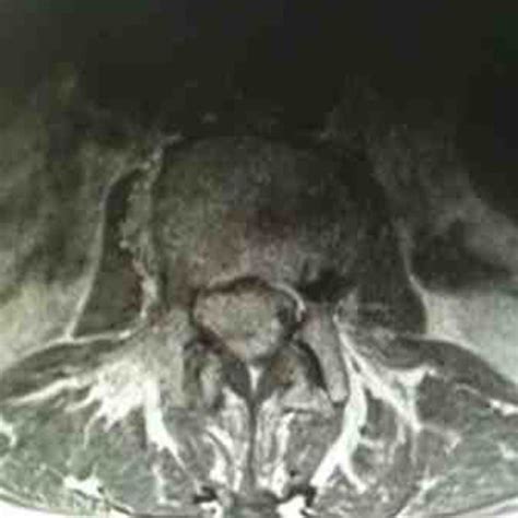 Ct Thorax Demonstrating The Thyroid Carcinoma With Retrosternal