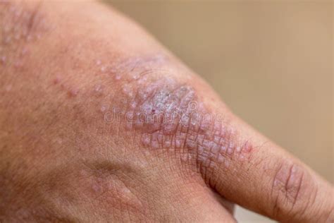 L Annuncio Della Dermatite Atopica Anche Conosciuto Come Eczema Atopico Un Tipo Di