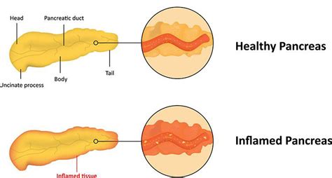 Tulane Liver And Pancreas Center ~ Acute Pancreatitis Tulane School Of