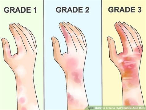 4 Ways To Treat A Hydrofluoric Acid Burn Wikihow