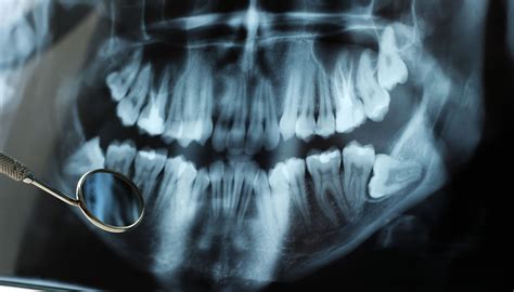 Impacted Wisdom Tooth Xray The Facial And Oral Surgery Center