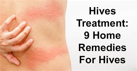 Hives Treatment 9 Home Remedies For Hives