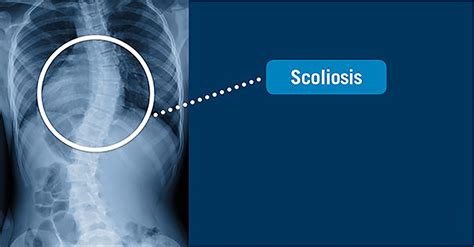 Scoliosis Usa Spine Care Laser Spine Surgery