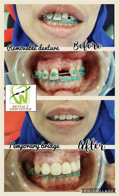 Ortodontis akan memasang 'expander yang memerlukan pesakit untuk memakai braces gigi selama beberapa minggu/bulan. KLINIK PERGIGIAN SYARIFAH: Nak pakai braces?