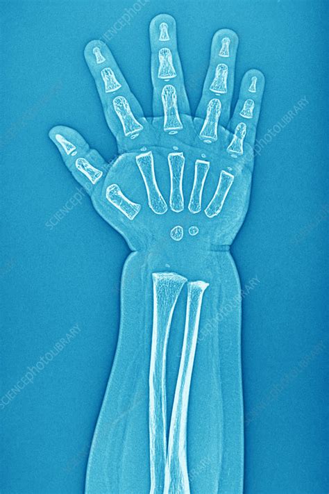 Normal Babys Hand X Ray Stock Image C0269074 Science Photo Library