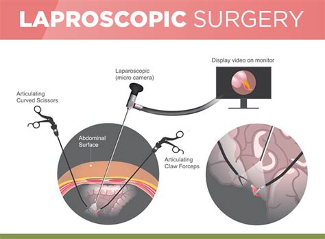 Laparoscopy Surgery Procedure Minimal Invasive Surgery