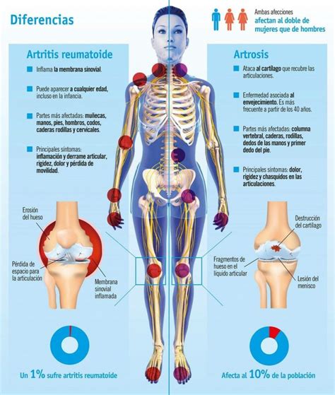 Infograf A De Diferencias Entre Artrosis Y Artritis Centro