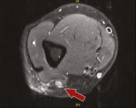 Localized Eosinophilic Fasciitis Shulmans Disease As A Differential