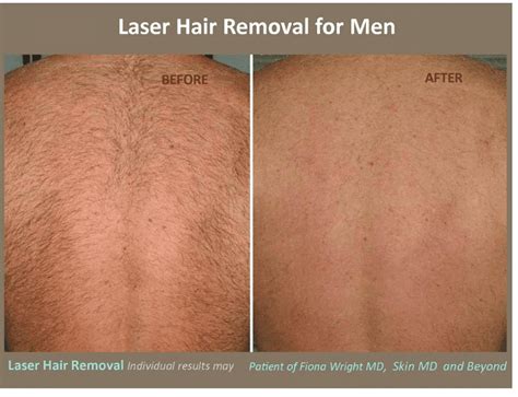 Laser Hair Removal Plano Tx Frisco Tx