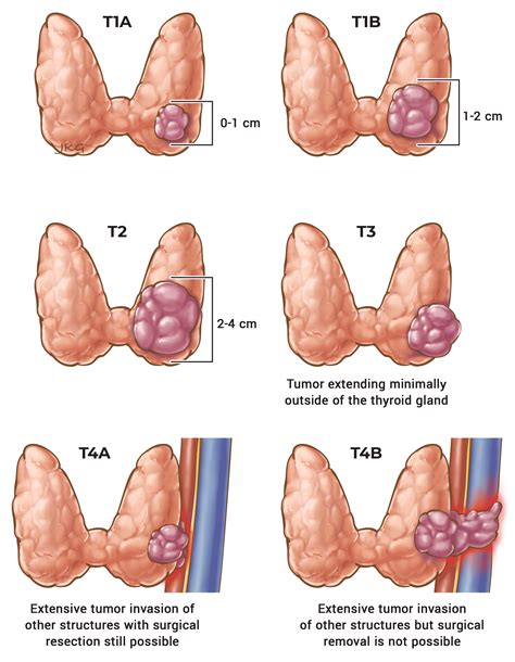 Initial Staging Response To Therapy Differentiated Thyroid Cancer