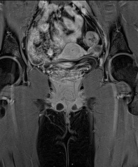 Bilateral Bartholin Gland Cysts Body Mr Case Studies Ctisus Ct