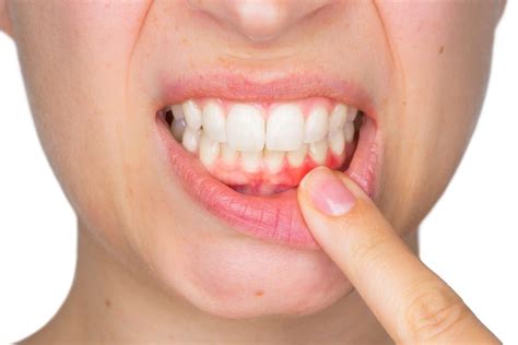 Gingivitis Causes And Symptoms