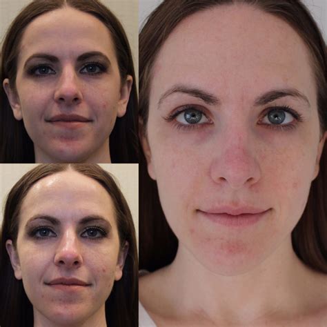 3 Week Update Microcurrent At Skinapeel Beauty The