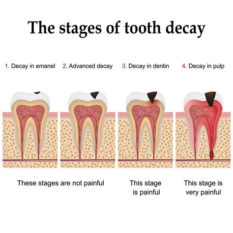 Stages Of Tooth Decay Cedar Creek Dental