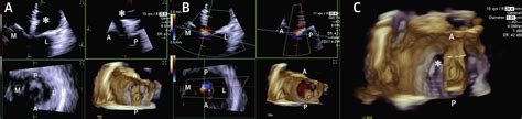 4 Dimensional Intracardiac Echocardiography In Transcatheter Mitral