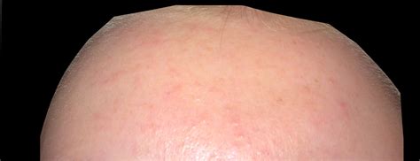 Tiny Bumps And Redness General Acne Discussion Forum