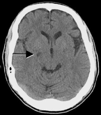 Axial Ct Scan Of Brain Without Contrast Small Lacunar Infarct