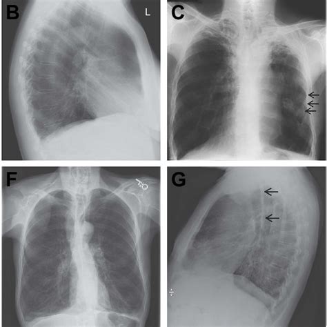 Cxr Findings In Patients With Copd Notes A Normal Download