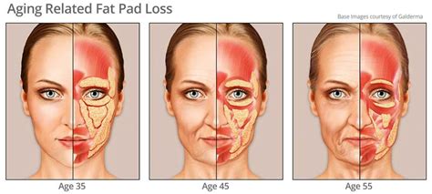 Understanding Facial Aging New Orleans La New Orleans Facial Aging