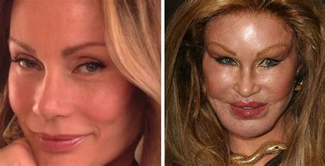 Best Before After Images Plastic Surgery Gone Wrong Celebrity My Xxx