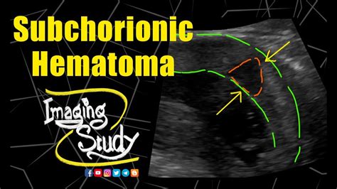 Subchorionic Hematoma Ultrasound Case 185 Youtube