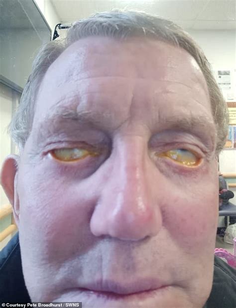 Pensioner Claims Botched £11000 Surgery Means He Hanst Been Able To Close His Eyes For Three
