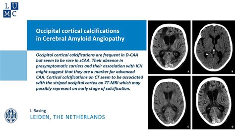 Occipital Cortical Calcifications In Cerebral Amyloid Angiopathy Stroke