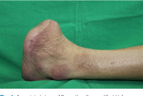 Figure 4 From Modified Lisfranc Amputation To Reduce Hematoma Rate In
