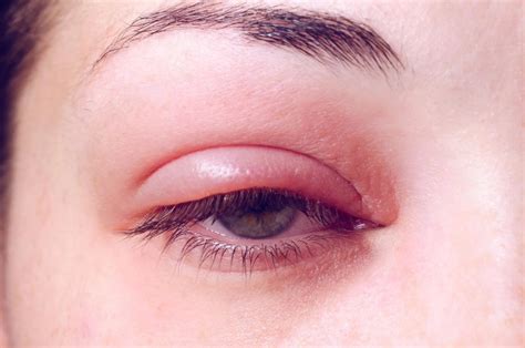 Swollen Eyelids Causes Symptoms Diagnosis Treatment Rxharun