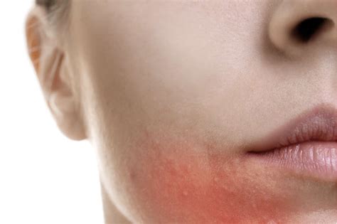 Nummular Eczema 10 Symptoms Of Nummular Eczema
